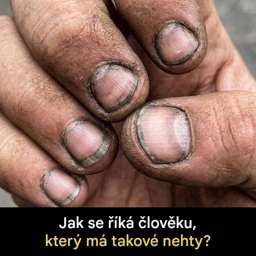 Jak se říká člověku, který má takové nehty?
