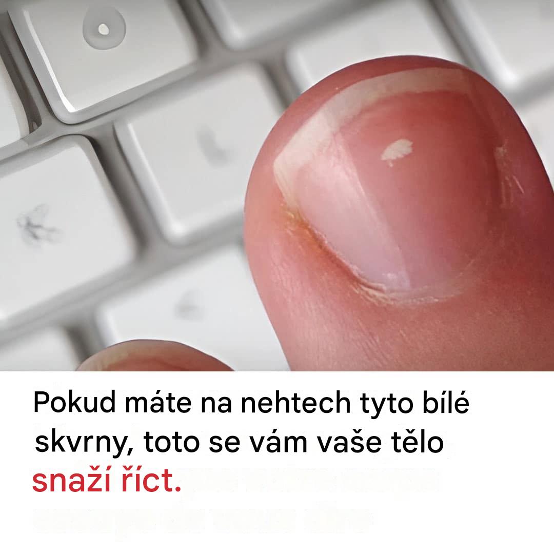 Bílé skvrny na nehtech: mýtus, nebo varovný signál?