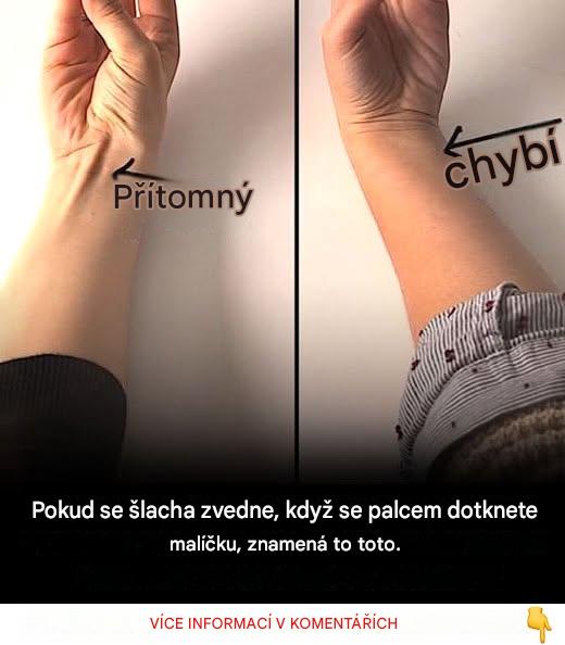 Pokud se šlacha zvedne, když se dotknete malíčku palcem, znamená to toto